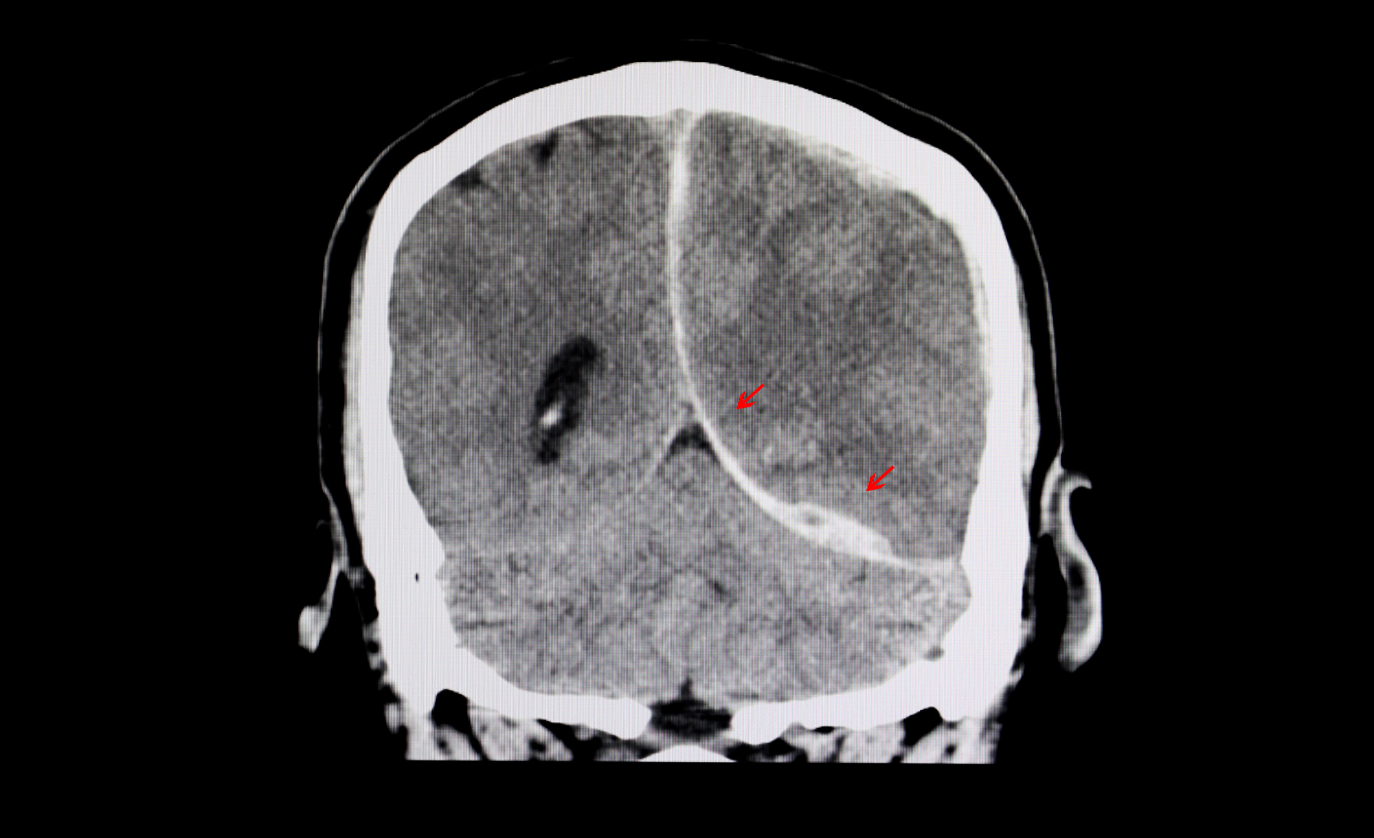 Brain Injury Lawyers